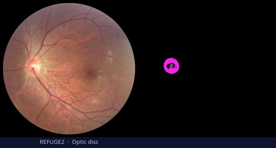 REFUGE2 optic disc — input vs DiGSeg