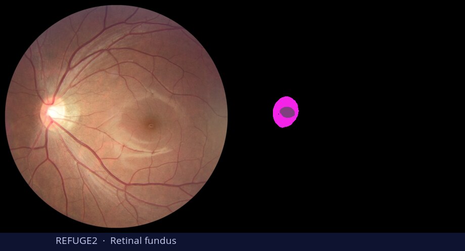 REFUGE2 retinal fundus — input vs DiGSeg