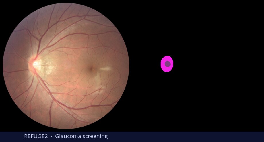 REFUGE2 glaucoma screening — input vs DiGSeg